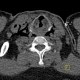Strangulation, suicidal attempt, emphysema of neck: CT - Computed tomography